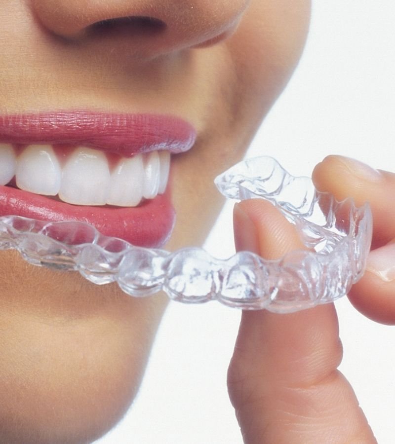 clínica bulla odontologia - invisalign 04